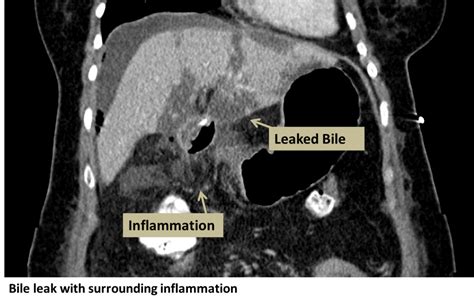 symptoms of bile leak|Bile Leak